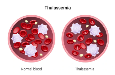 Thalassemia là gì