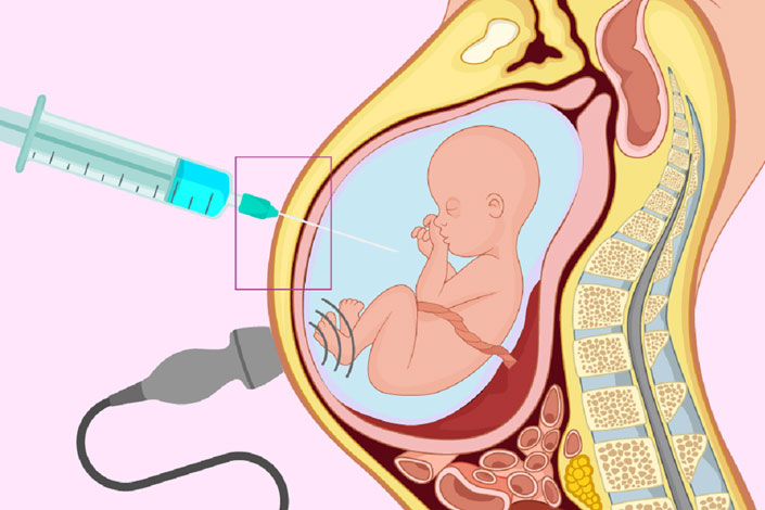 Kết quả chọc ối có chính xác không? Chọc ối có đau không?